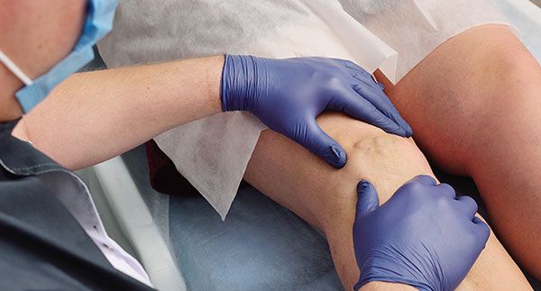 varices